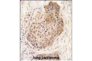 Formalin-fixed and paraffin-embedded human lung carcinoma tissue reacted with RIPK2 Antibody (C-term) (ABIN392274 and ABIN2841944) , which was peroxidase-conjugated to the secondary antibody, followed by DAB staining. (RIPK2 antibody  (C-Term))