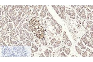 Immunohistochemistry of paraffin-embedded Human stomach cancer tissue using Cleaved-CASP3 p17 (D175) Polyclonal Antibody at dilution of 1:200. (Caspase 3 p17 (Cleaved-Asp175) antibody)