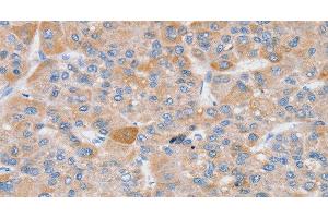 Immunohistochemistry of paraffin-embedded Human liver cancer using SLC25A13 Polyclonal Antibody at dilution of 1:35 (slc25a13 antibody)