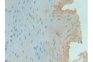 Detection of C1INH in Human Esophagus cancer Tissue using Polyclonal Antibody to Complement 1 Inhibitor (C1INH) (SERPING1 antibody  (AA 399-500))