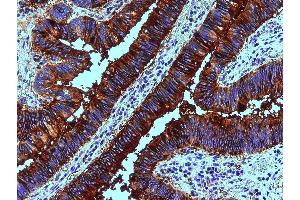 Immunohistochemistry staining of human colon adenocarcinoma (paraffin sections) using anti-blood group Lewis b (clone 2-25LE). (Blood Group Lewis B antibody)