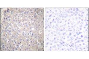 Immunohistochemistry analysis of paraffin-embedded human breast carcinoma tissue, using E-cadherin Antibody. (E-cadherin antibody  (AA 1-50))
