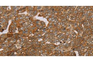 Immunohistochemistry of paraffin-embedded Human cervical cancer using PLEKHG6 Polyclonal Antibody at dilution of 1:45