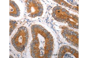 Immunohistochemistry of Human liver cancer using SLC12A6 Polyclonal Antibody at dilution of 1:40 (SLC12A6 antibody)