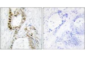 Immunohistochemistry analysis of paraffin-embedded human colon carcinoma, using FANCA (Ab-1149) Antibody. (FANCA antibody  (AA 1121-1170))