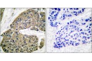 Immunohistochemistry analysis of paraffin-embedded human breast carcinoma tissue, using Keratin 5 Antibody. (Cytokeratin 5 antibody  (AA 541-590))