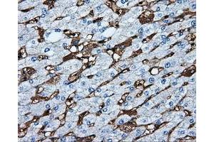 Immunohistochemical staining of paraffin-embedded Carcinoma of liver tissue using anti-MTRF1L mouse monoclonal antibody. (MTRF1L antibody)