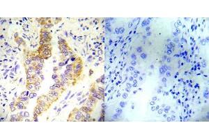 Immunohistochemical analysis of paraffin- embedded human lung carcinoma tissue using Tsc2 (Ab-1254) antibody (E022048). (Tuberin antibody)