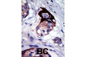 Formalin-fixed and paraffin-embedded human cancer tissue reacted with the primary antibody, which was peroxidase-conjugated to the secondary antibody, followed by AEC staining. (MARK3 antibody  (C-Term))