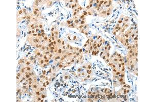 Immunohistochemistry of Human lung cancer using APPL1 Polyclonal Antibody at dilution of 1:70 (APPL1 antibody)