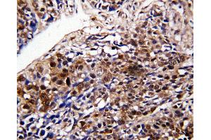Anti-DDT antibody, IHC(P) IHC(P): Human Lung Cancer Tissue (DDT antibody  (C-Term))