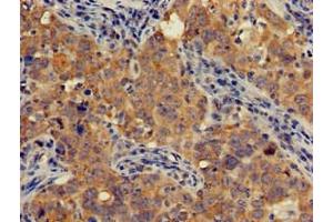 Immunohistochemistry of paraffin-embedded human pancreatic cancer using ABIN7143258 at dilution of 1:100 (AOAH antibody  (AA 180-254))