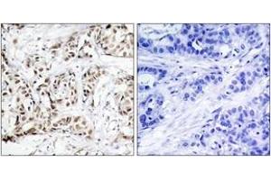 Immunohistochemistry analysis of paraffin-embedded human breast carcinoma, using SAPK/JNK (Phospho-Thr183) Antibody. (SAPK, JNK (AA 151-200), (pThr183) antibody)