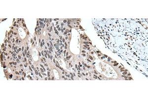 Immunohistochemistry of paraffin-embedded Human colorectal cancer tissue using ZBTB10 Polyclonal Antibody at dilution of 1:100(x200) (ZBTB10 antibody)