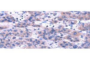 Immunohistochemistry of paraffin-embedded Human liver cancer using TRIM49 Polyclonal Antibody at dilution of 1/40 (TRIM49 antibody)