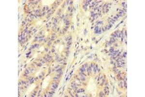 Immunohistochemistry of paraffin-embedded human colon cancer using ABIN7159762 at dilution of 1:100 (MAPRE1 antibody  (AA 2-268))