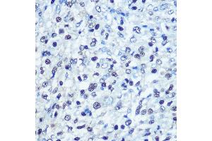 Immunohistochemistry of paraffin-embedded human liver cancer using [KO Validated] S Rabbit pAb (ABIN6132834, ABIN6147368, ABIN6147369 and ABIN7101817) at dilution of 1:100 (40x lens).