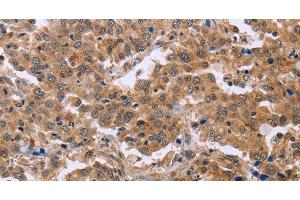 Immunohistochemistry of paraffin-embedded Human liver cancer using EPDR1 Polyclonal Antibody at dilution of 1:40 (EPDR1 antibody)