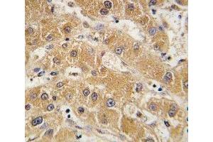 IHC analysis of FFPE human hepatocarcinoma tissue stained with APOA5 antibody (APOA5 antibody  (AA 22-52))