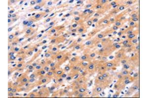 The image on the left is immunohistochemistry of paraffin-embedded Human liver cancer tissue using ABIN7192110(RAB39A Antibody) at dilution 1/5, on the right is treated with synthetic peptide.
