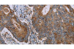 Immunohistochemistry of paraffin-embedded Human thyroid cancer tissue using CYP7A1 Polyclonal Antibody at dilution 1:30 (CYP7A1 antibody)