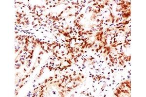 IHC testing of ovarian cancer stained with Estrogen Receptor beta antibody (ERb455). (ESR2 antibody  (C-Term))