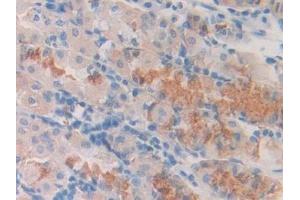 Detection of Slit1 in Human Stomach cancer Tissue using Polyclonal Antibody to Slit Homolog 1 (Slit1) (SLIT1 antibody  (AA 647-835))