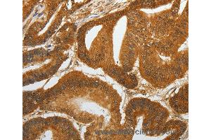 Immunohistochemistry of Human cervical cancer using RETNLB Polyclonal Antibody at dilution of 1:40