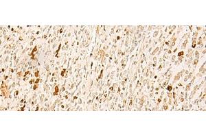 Immunohistochemistry of paraffin-embedded Human gastric cancer tissue using TBPL1 Polyclonal Antibody at dilution of 1:50(x200)