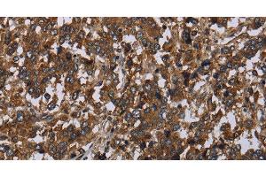 Immunohistochemistry of paraffin-embedded Human liver cancer tissue using HOMER2 Polyclonal Antibody at dilution 1:40 (HOMER2 antibody)