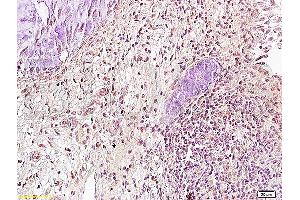 Formalin-fixed and paraffin embedded: human cervical carcinoma labeled with Anti-Runx3 Polyclonal Antibody (ABIN739370), Unconjugated at 1:300, followed by conjugation to the secondary antibody and DAB staining (RUNX3 antibody)