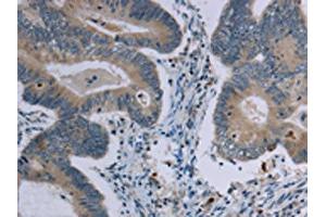 The image on the left is immunohistochemistry of paraffin-embedded Human colon cancer tissue using ABIN7191408(MARVELD1 Antibody) at dilution 1/40, on the right is treated with synthetic peptide. (MARVELD1 antibody)