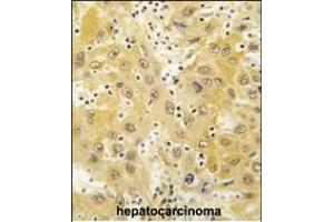 Formalin-fixed and paraffin-embedded human hepatocarcinoma tissue reacted with Tiparp antibody (N-term) (ABIN392513 and ABIN2842075) , which was peroxidase-conjugated to the secondary antibody, followed by DAB staining. (Tiparp antibody  (N-Term))