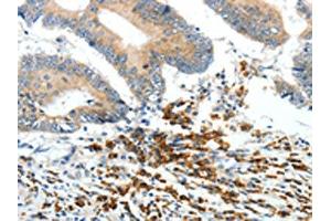The image on the left is immunohistochemistry of paraffin-embedded Human colon cancer tissue using (PTEN Antibody) at dilution 1/20, on the right is treated with synthetic peptide.