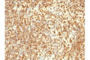 Formalin-fixed, paraffin-embedded human Lymphoma stained with CD20 Monoclonal Antibody (L26 + IGEL/773)