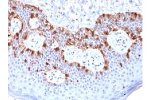 Immunohistochemical staining (Formalin-fixed paraffin-embedded sections) of human melanoma with MLANA recombinant monoclonal antibody, clone rMLANA/788 . (Recombinant MLANA antibody)