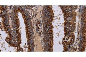 Immunohistochemistry of paraffin-embedded Human colon cancer tissue using PPP1R1B Polyclonal Antibody at dilution 1:50 (DARPP32 antibody)