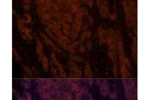 Immunofluorescence analysis of Human liver cancer using CXCL12 Polyclonal Antibody at dilution of 1:100. (CXCL12 antibody)