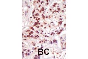 Formalin-fixed and paraffin-embedded human cancer tissue reacted with MAP3K8 polyclonal antibody  , which was peroxidase-conjugated to the secondary antibody, followed by DAB staining. (MAP3K8 antibody  (C-Term))
