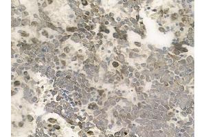 ABIN6257687 and ABIN6274287 at 1/100 staining human melanoma by IHC-P. (CEBPG antibody  (Internal Region))