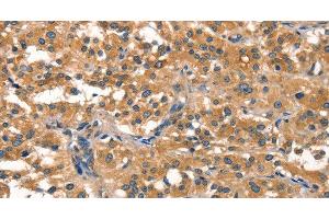 Immunohistochemistry of paraffin-embedded Human thyroid cancer using EIF4G1 Polyclonal Antibody at dilution of 1:30 (EIF4G1 antibody)