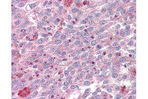 Anti-KLF4 antibody IHC of human melanoma. (KLF4 antibody  (AA 80-129))