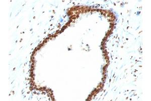 Formalin-fixed, paraffin-embedded human Colon Carcinoma stained with Double Stranded DNA Mouse Monoclonal Antibody (121-3) (dsDNA antibody)