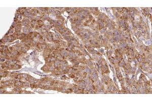 ABIN6267109 at 1/100 staining Human thyroid cancer tissue by IHC-P. (DAB1 antibody  (pTyr220))