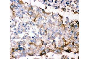 IHC-P: GFRA1 antibody testing of human lung cancer tissue (GFRA1 antibody  (AA 25-227))