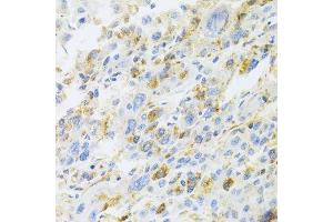 Immunohistochemistry of paraffin-embedded human liver cancer using CXCR3 Antibody. (CXCR3 antibody)