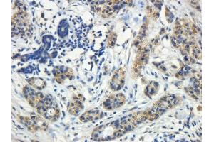 ABIN4902755 (5µg/ml) staining of paraffin embedded Human Breast cancer. (ROR1 antibody)