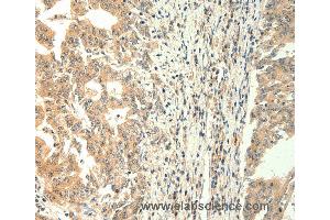 Immunohistochemistry of Human gastric cancer using TRPM5 Polyclonal Antibody at dilution of 1:60 (TRPM5 antibody)