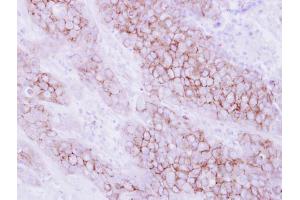 IHC-P Image Immunohistochemical analysis of paraffin-embedded human breast cancer, using KIR2DL4, antibody at 1:250 dilution. (KIR2DL4/CD158d antibody  (Center))