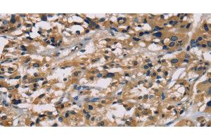 Immunohistochemistry of paraffin-embedded Human thyroid cancer tissue using hCG Polyclonal Antibody at dilution 1:65 (hCG antibody)